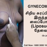 Treatment for puffy nipple grade 1 gynecomastia at Tamira Chennai
