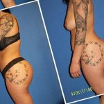 Butt Implants Before After Photos
