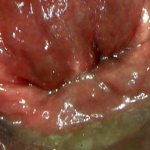 ANAL ENDOSCOPY