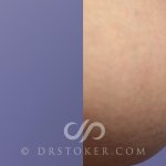 Nipple Reduction Surgery Los Angeles